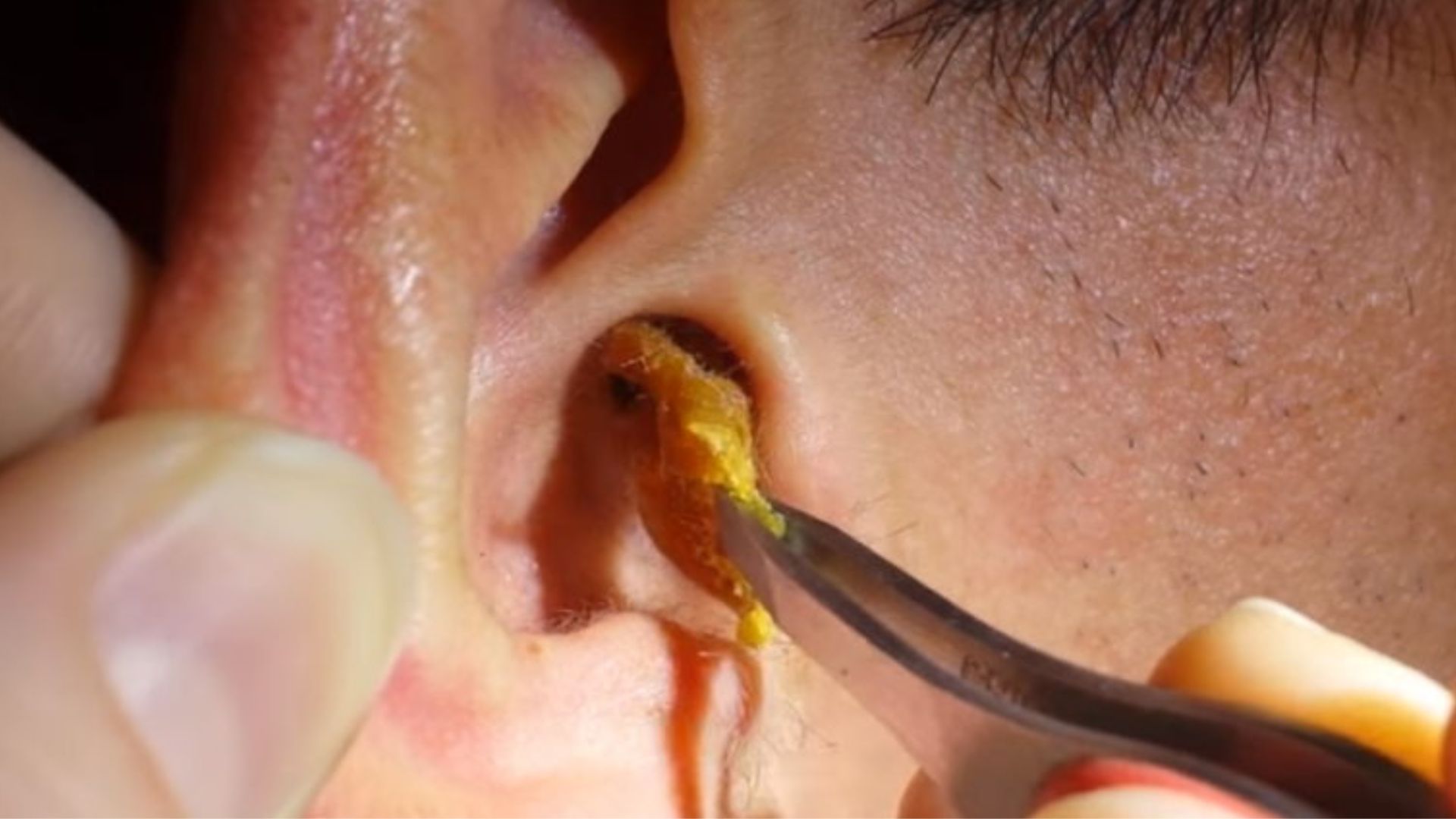 Earwax Dream Meaning: What Your Ear Wax Dreams Really Symbolize 2 Earwax Dream Meaning: What Your Ear Wax Dreams Really Symbolize